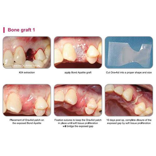 Ora-Aid conceptual intaoral wound dressing strip