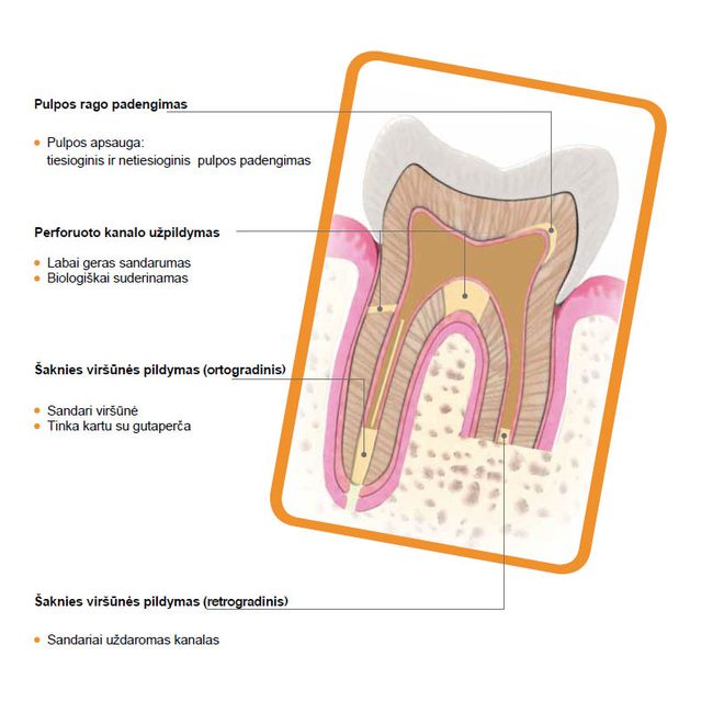 Harvard MTA endodontinis