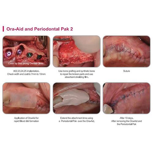 Ora-Aid conceptual intaoral wound dressing strip